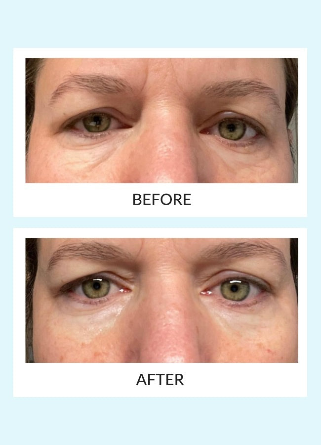 Reusable Eye Therapy Patches (6 pairs) & Case